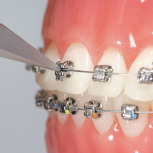 Кришка брекетів Damon Q2