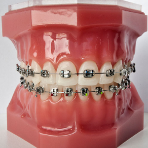 Брекети Damon&trade; Q2